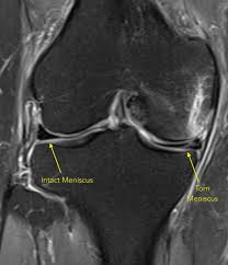 Torn meniscus cause, signs & symptoms, test, diagnosis, recovery, recovery time, surgery & treatment. Meniscus Tear Huang Orthopaedics
