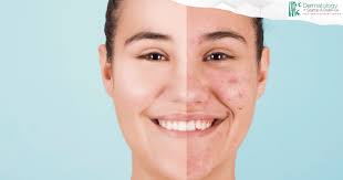 Acne Treatment in Bellevue