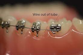 If it was on the bottom maybe, but both the troublesome ends are on the top. Ortho Care From Home Sayre Orthodontics Bozeman Mt