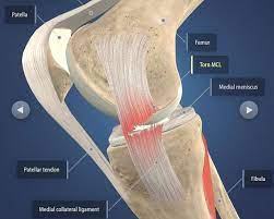 It is really important to follow the advice of your surgeon and physio and to rigidly stick to your rehab and recovery programme. The Do S And Don Ts After Acl Mcl Tears Surgery Heiden Orthopedics