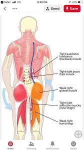 Pin On Scoliosis