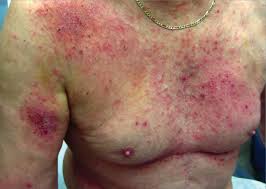 Image result for Atopic Patient