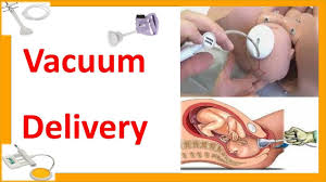 Image result for Vacuum Caput