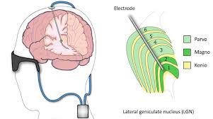 Image result for Thalamic Stimulation