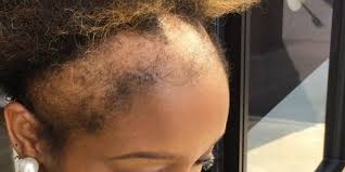 When it comes to achieving flowing locks, it boils down to two key factors: This Woman S Honesty About Her Hair Loss Will Make You Think Twice About Your Style Self
