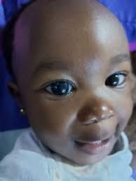 Congenital Glaucoma and Dr Ahmad Khalil