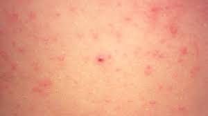 Image result for scabies human bites