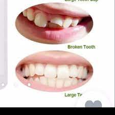 Kelinci memiliki gigi berjumlah 28 gigi yang digunakan untuk mengunyah makanan. Terlaris Gigi Palsu Temptooth Temporary Tooth Lem Tambal Gigi Instan Kuat Untuk Memperbaiki Gigi Berlubang Ompong Patah Gigi Renggang Bisa Bentuk Gigi Kelinci Bisa Cod Lazada Indonesia