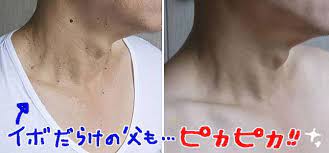 必見 首イボがたった二週間で ポロッと消えた 皮膚科医歴12年の医師が絶賛してる イボ専用クリーム が凄すぎる 首 イボ 皮膚科 美容