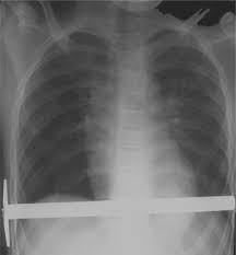 The degree to which you can do something about. Pectus Excavatum Springerlink