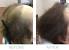 Prp Hair Treatment Side Effects