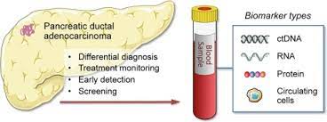Second, pancreatic cancer usually does not produce noticeable symptoms until it spreads to other organs. Blood Biomarkers For Differential Diagnosis And Early Detection Of Pancreatic Cancer Cancer Treatment Reviews