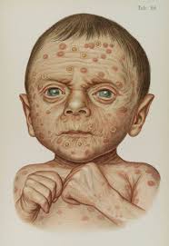 Illustration of baby diseased with hereditary Syphilis