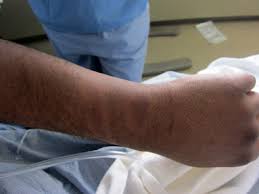 We did not find results for: Treatment Of Minor Thermal Burns Uptodate