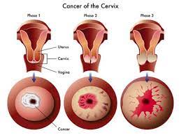 These have enough detail to show exactly where a cancer is, whether it has spread elsewhere and, by comparing with earlier scans, any changes in size. Higher Cervical Cancer Rates Baseline Of Health