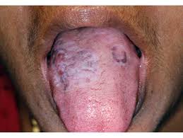 Image result for lichen planus on tongue)
