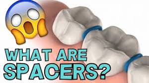We did not find results for: Are Spacers The Worst Part Of Braces