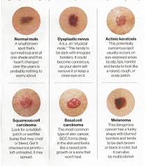 Image result for skin mole