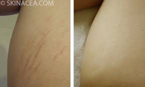 Bio Oil White Stretch Marks Before And After How To Get Rid Of Stretch Marks Skinacea Com Stretch Marks Red Stretch Marks Stretch Mark Remedies