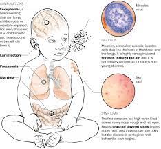 How To Recognize Measles - The Washington Post