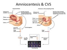Image result for Chorionic Villus Sampling