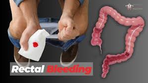 Image result for blood in stool human poop
