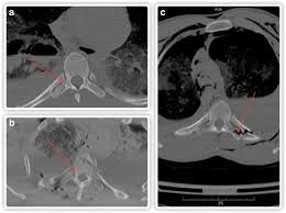 There is a strong association between transverse process fractures and other traumatic injuries. Transverse Process Fractures Of The Thoracic Vertebrae The Significance Of This Injury In The Context Of Medicolegal Opinions On High Energy Trauma Cases Springerlink