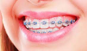 What To Do If My Braces Bracket Comes Off Weber Orthodontics
