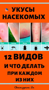 что делать при боли в спине в домашних условиях Ukusy Nasekomyh 12 Vidov I Chto Delat Pri Kazhdom Iz Nih V Domashnih Usloviyah Narodnye Recepty Ukusy Nasekomyh Naturalnaya Medicina Zdorove