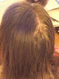 Essential, protective oils are washed out of the hair with each shampoo. Thinning Hair Oily Roots Dry Ends Curltalk
