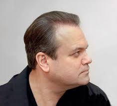 Shaun Williamson Hair Transplant Results
