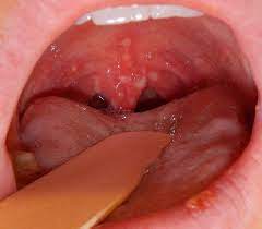 Lumps on mouth can be hard and small depending on what the underlying cause is. Herpangina Wikipedia