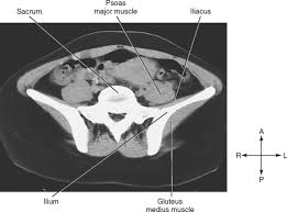 Ct anatomy of the pelvis. The Pelvis Basicmedical Key