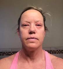 I would love for other women to join this. Hima Dalal has helped me so much  with my scar tissue from my DMX. She has been working with breast cancer  patients for