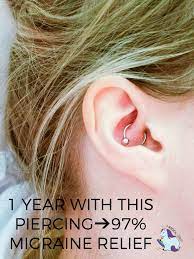Migraine Piercing 1 Year Results Natural Headache Remedies Migraine Piercing Natural Headache