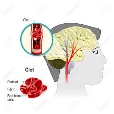 Cerebrovascular disease includes stroke, carotid stenosis, vertebral stenosis and intracranial cerebral angiography (also called vertebral angiogram, carotid angiogram): Cerebral Infarction Brain Stroke The Obstruction Is Caused Royalty Free Cliparts Vectors And Stock Illustration Image 71630924