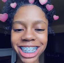 Braces Colors Black And Blue Image Result For Aqua Blue Braces Braces For More Follow Tontaaay The Color Is Aqua Blue Cute Braces Teeth Colors Cute Braces Colors Cute Braces