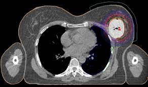 Abdominal ct scan is a diagnostic imaging technique that provides a clear picture of the state of internal organs located in the abdominal region. Breast Cancer Transverse Ct Scan Of Contura Application Final Download Scientific Diagram