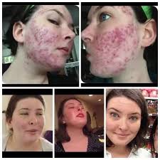Unfortunately, this look does not quite go in florida. How To Look Good Without Makeup If You Have Acne Saubhaya Makeup