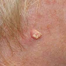 These and other types of skin cancers can also look different from the descriptions above. What Does Squamous Cell Carcinoma Look Like