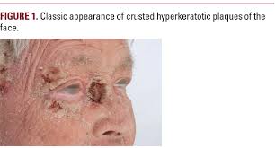 Image result for scabies norvegica