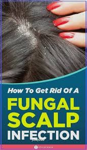 Dry hair can result from: How To Get Rid Of Fungal Scalp Infection 8 Natural Remedies In 2021 Dry Scalp Treatment Diy Oil For Hair Loss Hair Loss Treatment