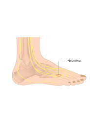Morton S Neuroma Treatment Boston Foot Ankle Biologics