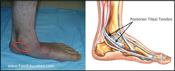 The word ankle refers to the angle between the leg and the foot. Acquired Adult Flatfoot Deformity Footeducation
