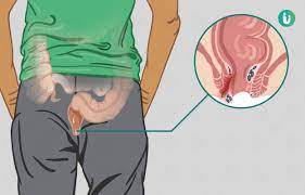 Cbing2020@outlook.com or fistulabahb666@outlook.com euro booking Anal Fistulas Vein Cure Clinic