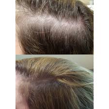 These include iron, niacin, biotin, calcium, and so much more. These Next Level Combination Treatments Deliver Transformative Hair Growth Newbeauty