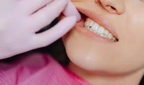 Front Tooth Root Canal: Does It Hurt or...