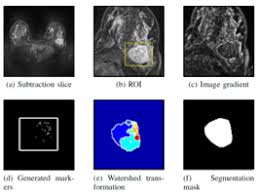 On the flip side, there are benign (not cancerous) breast changes which can mimic breast cancer as well. Breast Tumor Lesions Segmentation