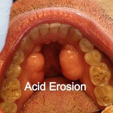 Pin On Gerd Reflux Info