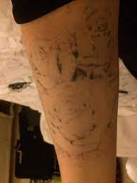 That's why we created this guide to getting a tattoo removed. Picosure Tattoo Laser Success Stories Home Facebook